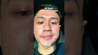 UPDATE AFTER DERMAPEN 15 dermapen dermapenmicroneedling [upl. by Boff]