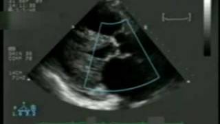 2D Echocardiogram with Doppler [upl. by Kotta]