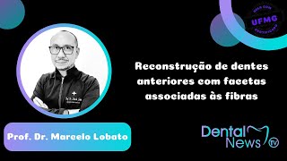 Reconstrução de dentes anteriores com facetas associadas às fibras [upl. by Ytiak469]