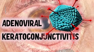 VIRAL CONJUNCTIVITIS  Ultimate Guide to Recognising Clinical Presentations [upl. by Teagan707]