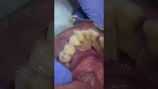 Dental cleaning dental hygiene lyrics musica viral youtubeshorts smile shorts dentist fyp [upl. by Haida]