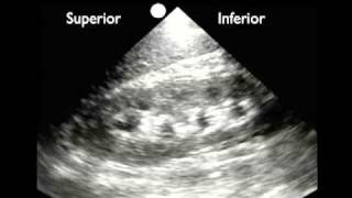 How To Renal Ultrasound  Hydronephrosis Case Study Video [upl. by Ottinger]