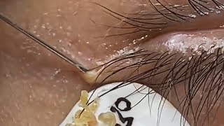 Deep blackhead extraction Cystic acne amp pimple popping 95 [upl. by Nodyroc]