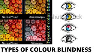 TYPES OF COLOUR BLINDNESS  PROTANOPIA TRITANOPIA DEUTERANOPIA [upl. by Ycnuahc]