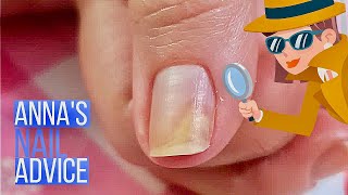 Nail Separation  Causes  Early Treatment of Onycholysis Annas Nail Advice [upl. by Lehcer]