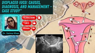 Displaced IUCD Causes Diagnosis and Management – Case Study healthytips DrSaimakhan [upl. by Edithe]