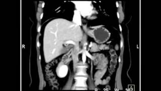 Abdomen Stomach Inferior epigastric arteries 3D Reconstruction for DIEP Block Surgery2 of 2 [upl. by Ahsiekar]