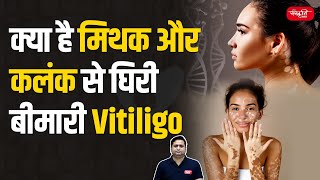 Vitiligo Skin Disease  Myths Stigma and Facts About This Skin Condition  UPSC [upl. by Nidya]