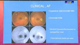 AIOC2020 IC395 T4 Dr Awaneesh Upadhyay Emerging concept of Peripapillary Pachychoroid Syndrome PPS [upl. by Lauryn522]