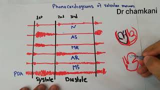 CVS 233  Phonocardiograms of valvular murmurs  Aortic and mitral [upl. by Rasaec836]