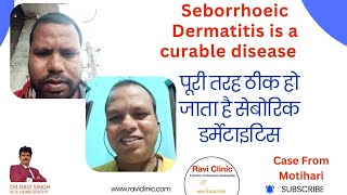 Seborrhoeic Dermatitis Got cured 100  in Online Patient with Homeopathy [upl. by Kung]