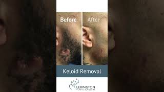 Keloid Removal Before and After [upl. by Udele46]