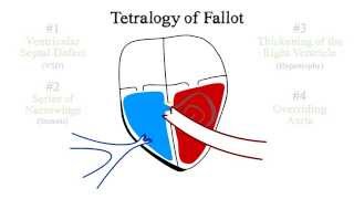 Tetralogy of Fallot [upl. by Amluz612]