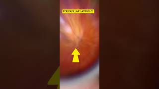 Peripapillary ATROPHY myopic fundii [upl. by Liponis]