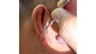 Removing Grandpas 70 Year Old Hard Earwax [upl. by Linkoski]