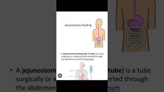 feeding procedure jejunostomy feeding [upl. by Aleinad]