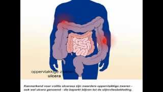 Colitis ulcerosa  Wat zijn de symptomen en behandeling van colitis ulcerosa [upl. by Charleen676]