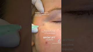 How to Safely amp Effectively Use Botox for Brow Lift [upl. by Rhys]