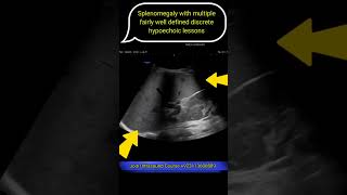 Splenomegaly with multiple fairly well defined discrete hypoechoic lessons ultrasound shorts [upl. by Lladnew]