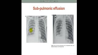 PleuralEffusionDiagnosticApproach [upl. by Nesrac]