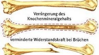 Osteoporose Knochenschwund und die richtige Ernährung [upl. by Hound]