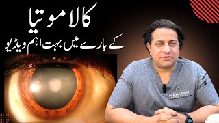 Kala Motia ka ilaj in Urdu Hindi  Glaucoma treatment [upl. by Lev]