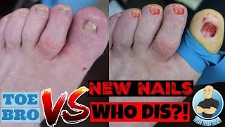 CAUSE OF AND CURE FOR THICK TOENAILS  FULL EXPLANATION amp TREATMENT [upl. by Seira902]