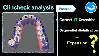 Expansion in Aligners｜【Chris Chang Ortho】CC812 [upl. by Joscelin]