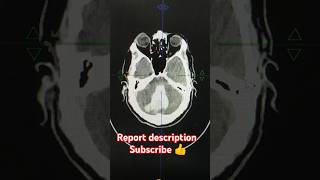 ncct head pathology detail report description radiology anatomy pathology hemantkushwah3453 [upl. by Tletski875]