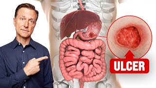 The FASTEST Way to Heal an Ulcer [upl. by Danielle]