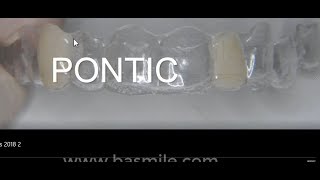 Pontic  facette dentaire en orthodontie par Aligneur et Invisalign [upl. by Nanoc646]