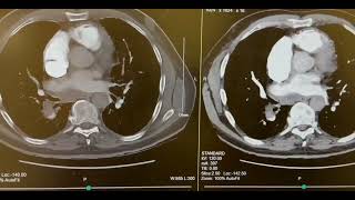 CT Angio Pulmonary Embolism WIth Contrast [upl. by Annid754]