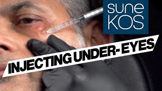 How To Inject Under Eyes With Sunekos pigmentation texture wrinkles [upl. by Neel465]