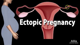 Ectopic Pregnancy Animation [upl. by Iver]