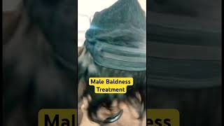 mintop 5  male baldness treatment  hairline loss treatment  9643760504 [upl. by Lidia]