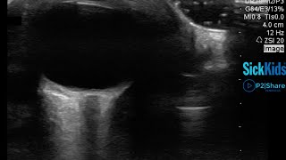 Diagnosing An Orbital Abscess Using Ocular POCUS [upl. by Nulubez]