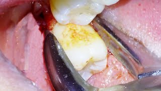 Dentist Easily Extracts Wisdom Teeth on Erupted 3rd Molars [upl. by Eniamrehc309]