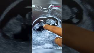 Early pregnancy scan  pregnancy confirmation  twin pregnancy  gynaecologist doctorsvlogs [upl. by Katherina]