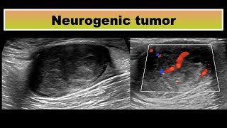 Neurogenic tumor in thigh [upl. by Yremogtnom187]