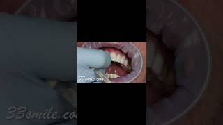 Correcting discolored teeth with prepless veneers before and after [upl. by Hawkie]