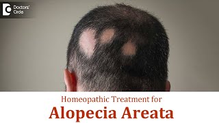 Patchy hair loss  Alopecia Areata  Causes Symptoms amp Homeopathic Treatment  Dr Surekha Tiwari [upl. by Gaige]