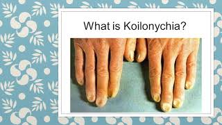 WHAT TO KNOW ABOUT KOILONYCHIA  NAIL DEFORMITIES  CLINICAL MEDICINE  MBBS REVISION GUIDE [upl. by Orgell]