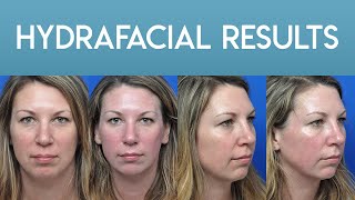 HydraFacial Results [upl. by Noseyt]