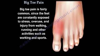 Big Toe Pain  Everything You Need To Know  Dr Nabil Ebraheim [upl. by Nhguahs]