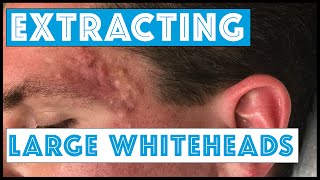 Acne Vulgaris and Extracting large Whiteheads  Part 1 [upl. by Yrreg]