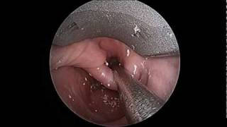 Zenkers Diverticulum Prior to Endoscopic Repair [upl. by Hege]