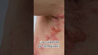 ¿La culebrilla es contagiosa  Dr William Guerrero medicina shorts [upl. by Katharyn980]