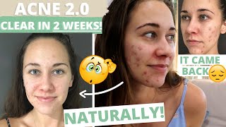 ACNE 20  How to get rid of CYSTIC acne NATURALLY in TWO WEEKS [upl. by Deonne41]