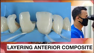 Step by step Layering Anterior Composite  General Dentist Griya RR [upl. by Athene]