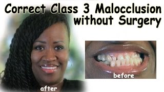 Correct Class 3 Malocclusion without Surgery  Bergen County NJ Dentist [upl. by Townsend]